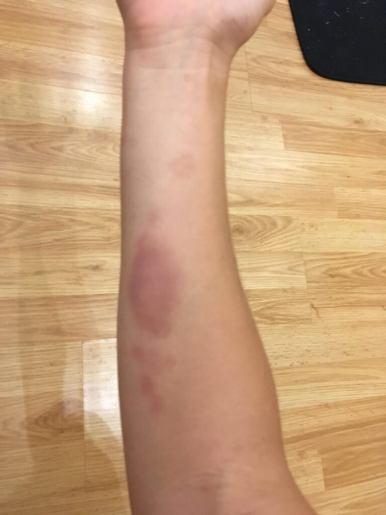 How To Avoid Getting Volleyball Bruises